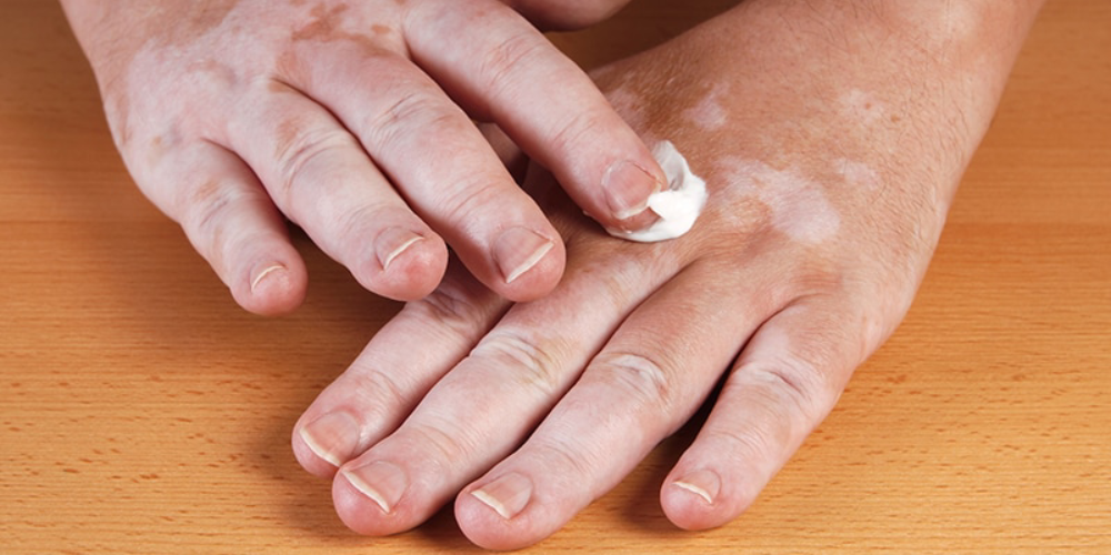 vitiligo-treatment-separet-page-blog