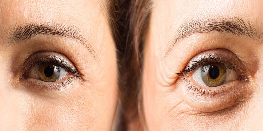 laser-eye-wrinkle-reduction-blog